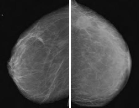Other Tumor Forms 129 MR mammography: Inflammatory carcinoma T1-weighted sequence (precontrast) Skin thickening is often the only feature suggestive of malignancy (differential diagnosis: irradiated