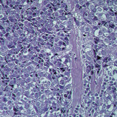 120 9 Malignant Changes Medullary Carcinoma The histopathological features that define the typical form of medullary carcinoma are a tendency for tumor cells to grow in broad sheets without distinct
