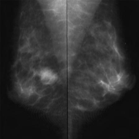 Invasive Tumor Forms 121 MR mammography: Medullary carcinoma T1-weighted sequence (precontrast) Well-circumscribed, hypointense lesion, difficult to