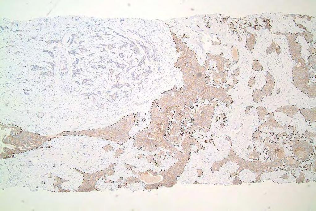 p63 Complex sclerosing lesion with