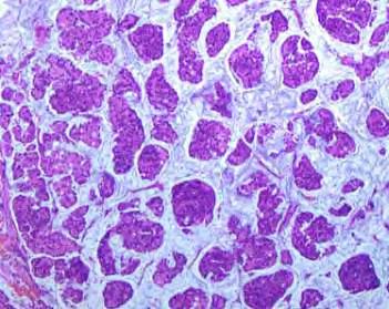 Circumscribed, bosselated; gelatinous cut surface Micro: Neoplastic cell