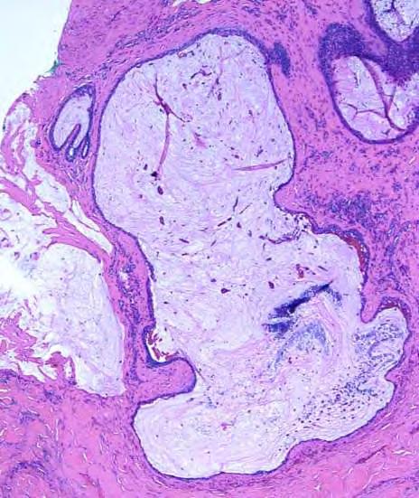 Mucocele-Like Lesion Palpable mass, mammographically detected, or incidental Gross: Gelatinous cut surface Micro: