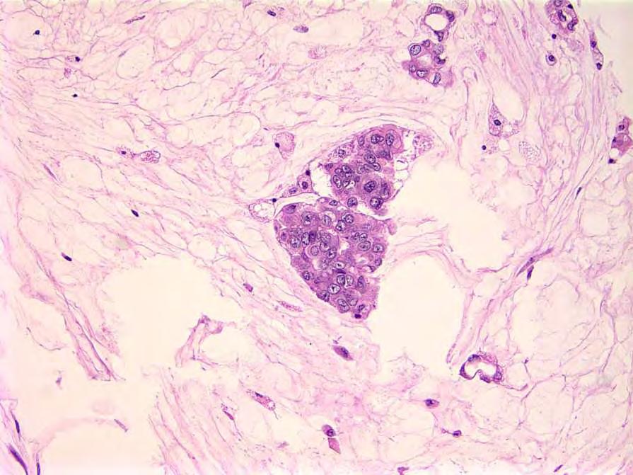 Mucin Pools + Neoplastic Cell Nests =