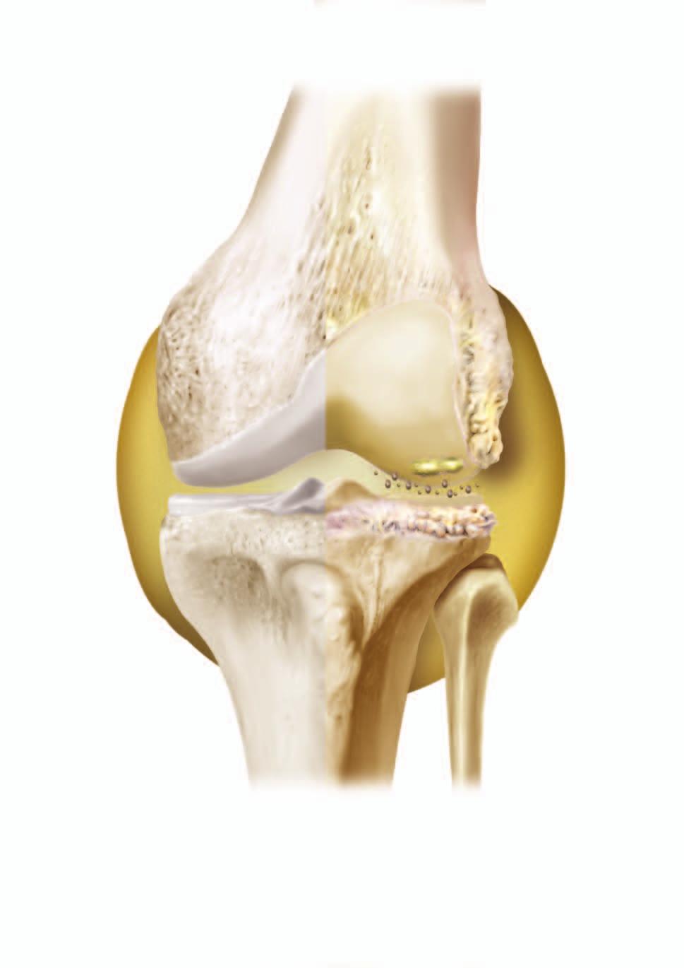 Normal knee vs OA knee: What s different inside?
