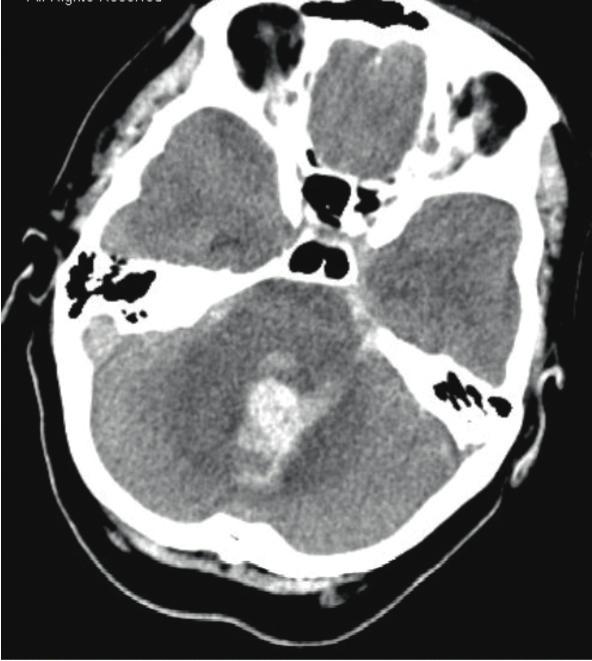 Figures 1 and 1 () Unenhanced CT brain showing predominantly