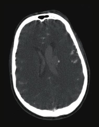 (C) CT also show a tiny aneurysm intimately related
