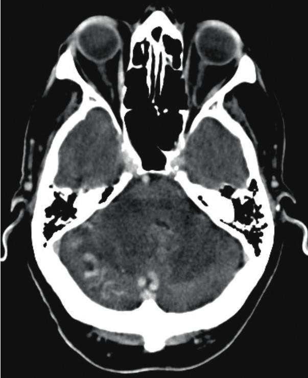 VM. Figures 4 and 4 () CT showing a right