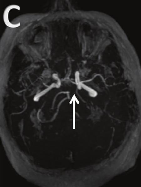Important potential consequences of this fetal variant of the circle of Willis have been demonstrated, but studies are conflicting.