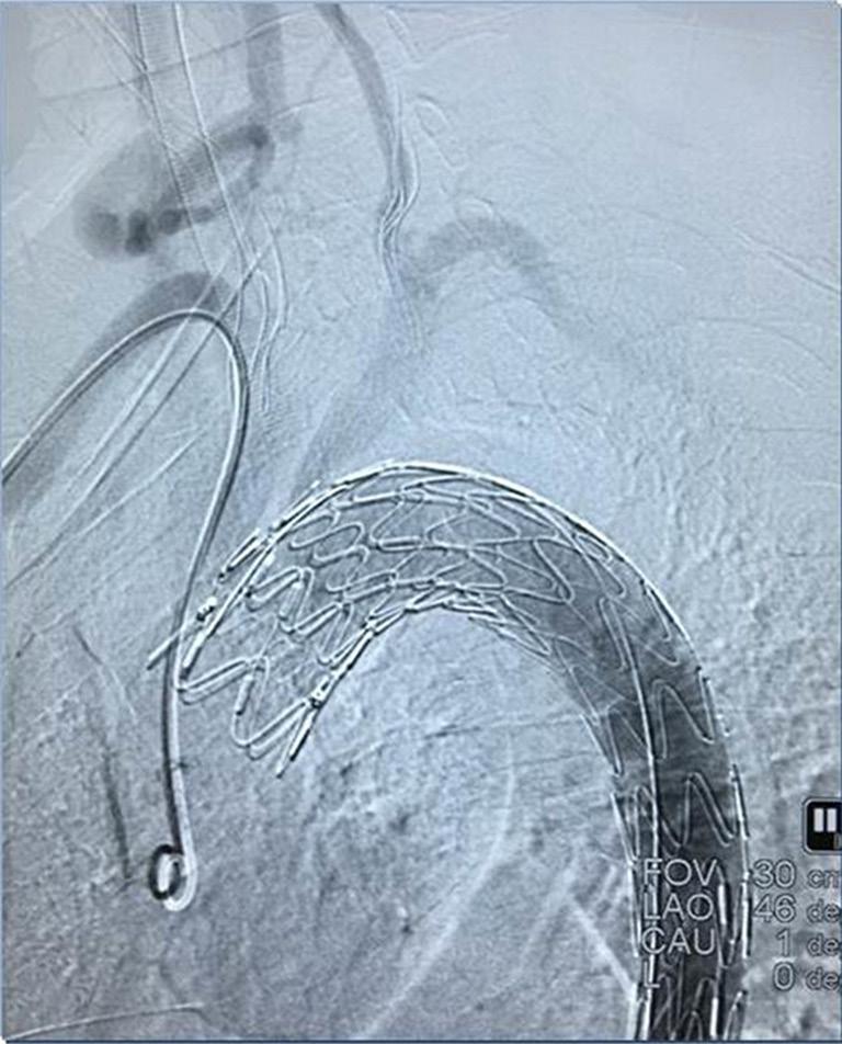 The procedures for the aortic-arch-branch-vessel bypass were (I) occlusion of the right common carotid artery, followed by anastomosis of the right common carotid artery-artificial vessel and opening