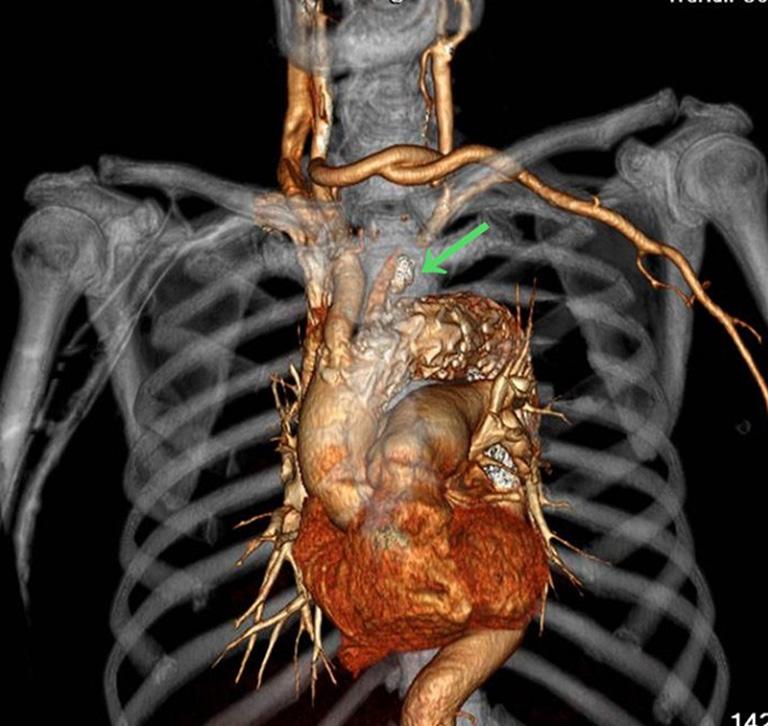 carotid artery-left common carotid artery-lsa bypass surgery was performed in three patients (Figure 5); 6 of these 7 patients underwent proximal LSA ligation, showing no obvious blood flow in the