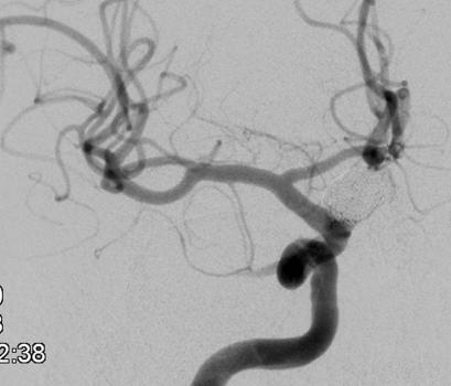 Figure 1. Angiogram images from a 62 year-old male with an unruptured aneurysm.