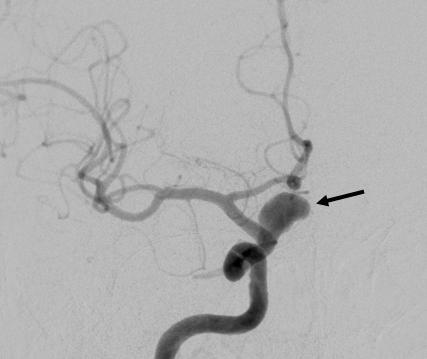 Images after endovascular therapy show coils (arrow, lower left) in the aneurysm. Angiogram following coiling shows no residual filling of the aneurysm (lower right).