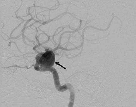While these results from a landmark study cannot be generalized to every patient, they suggest that if a patient has subarachnoid hemorrhage and an aneurysm that can be treated with either modality,