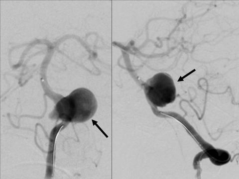 Figure 3. Treatment of a complex, large aneurysm at the vertebro-basilar junction using a flow diverting stent.