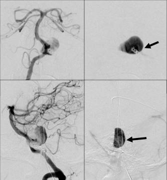 thrombosis. Final post treatment angiogram (lower left) shows stasis of contrast (arrows) well after contrast has washed out of the normal arteries and veins.