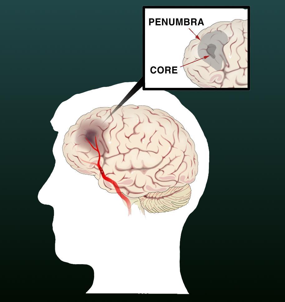 Physiology Time is Brain is Brain Cerebral Blood Flow Thresholds CBF 100 100 ml / 100 gm / min 90 80 70 Normal Penumbra = Ischemia - Infarction Penumbra = NIHSS - CT/MR