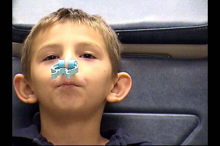 Speech Therapy While waiting for surgery to correct VPI: Use nose plugging technique Gives the child
