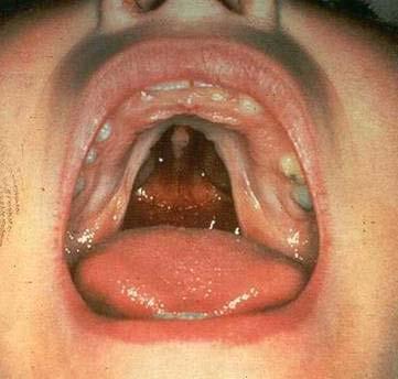 History of Cleft Palate Velum may be too
