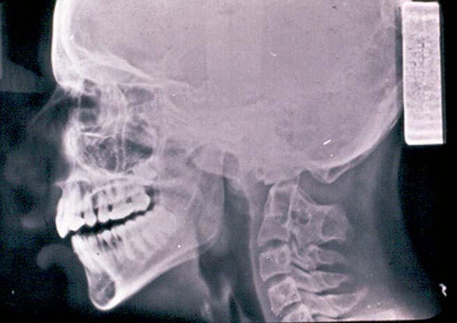 Deep Pharynx Can be due to cranial base or cervical spine