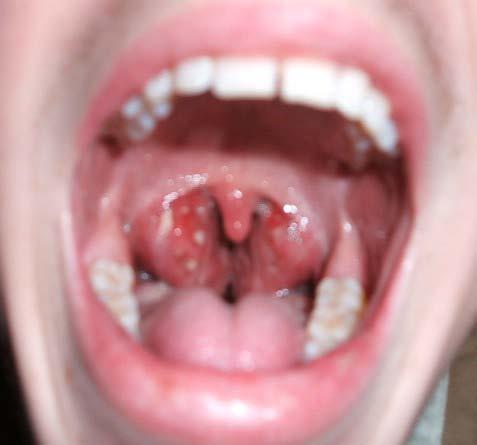 Enlarged Tonsils Tonsils block