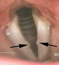 Dysphonia Vocal cord nodules due to strain in the vocal tract with VPI Laryngeal anomalies with
