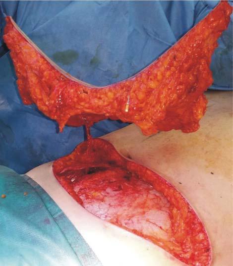 A 2010 study shows that patients who received breast reconstruction with latissimus dorsi flap had developed seromas of the donor area, that were evacuated percutaneously.