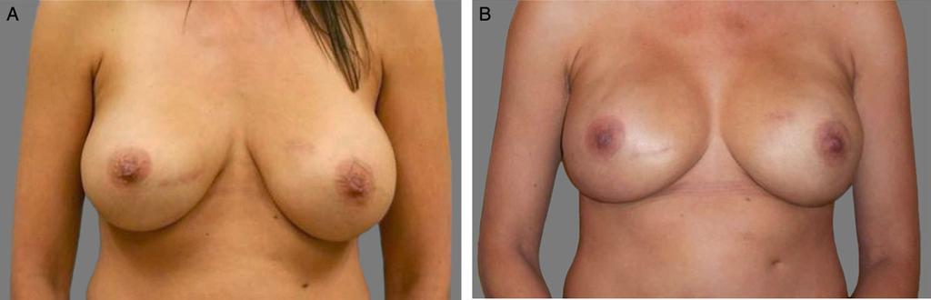 Single-stage reconstruction was performed with a 425 cc shaped silicone implant. Patient shown preoperatively (A) and one year postoperatively (B). Figure 2.