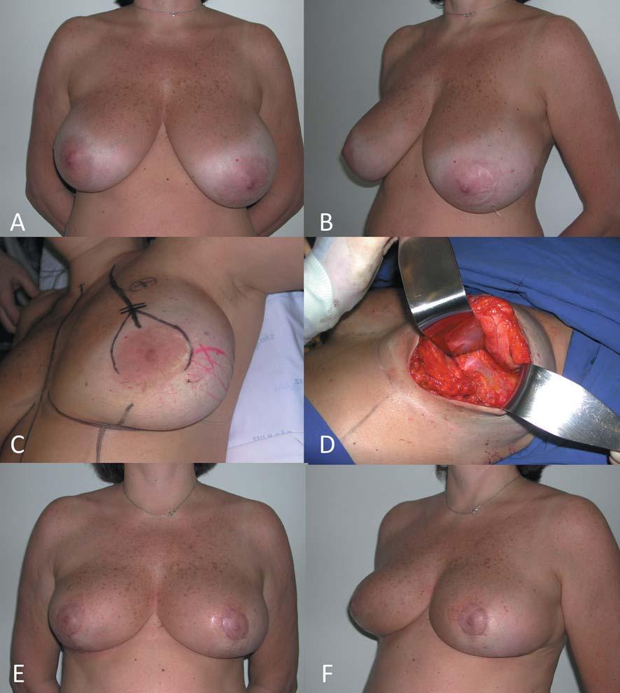 Munhoz et al: Conservative Breast Surgery Reconstruction Figure 2. A 47-year-old patient with invasive ductal carcinoma (2.6 cm) of the right breast (A-B, above left and right).
