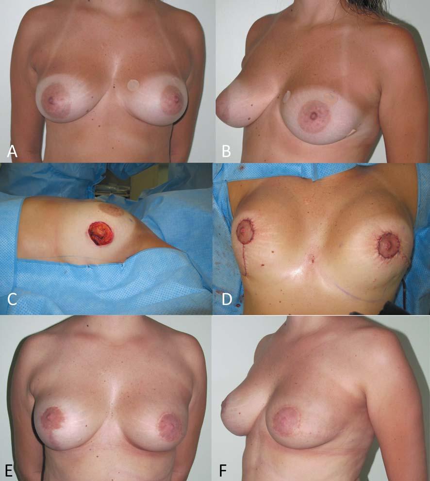 Figure 3. A 53-year-old patient with invasive ductal carcinoma (3.5 cm) of the lateral quadrant of the left breast (A-B, above left and right).