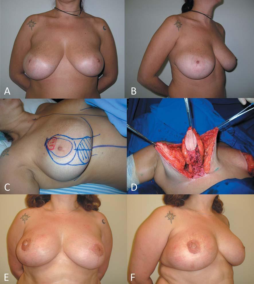 Munhoz et al: Conservative Breast Surgery Reconstruction Figure 4. A 44-year-old patient with invasive ductal carcinoma (2.