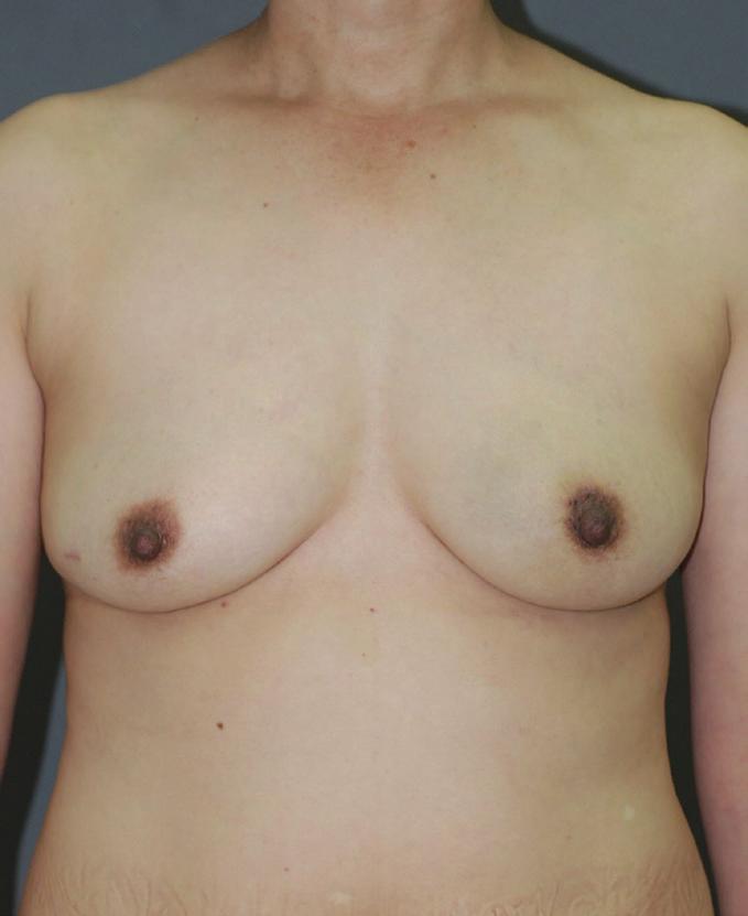 Park HC et al. Oncoplasty for central breast cancer Fig. 4.