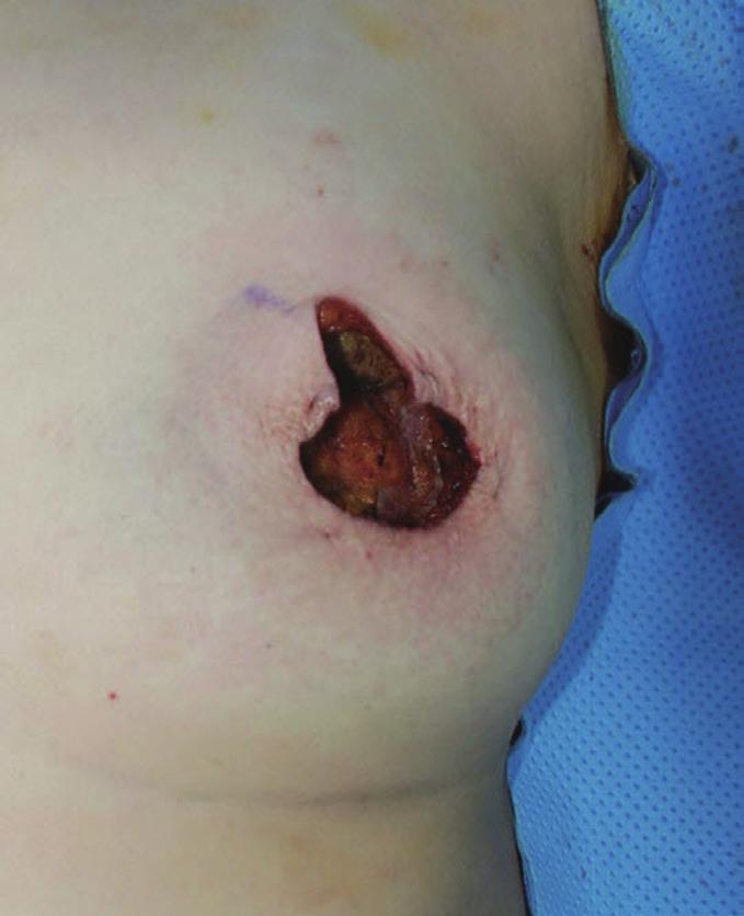(B) Intraoperative view of partial mastectomy (weight of tumor, 60 g). (C) 10-month postoperative outcome. A B C Fig. 5.