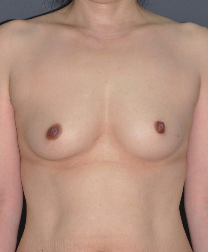 (C) 19-month postoperative outcome. A B C the nipple. Follow-up core needle biopsy confirmed the presence of an IDC.