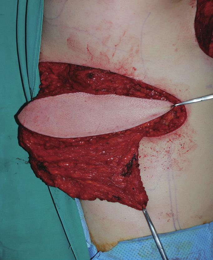 (B) Intraoperative view of elevated latissimus dorsi flap after partial mastectomy (weight of tumor, 206 g). (C) 30-month postoperative outcome.