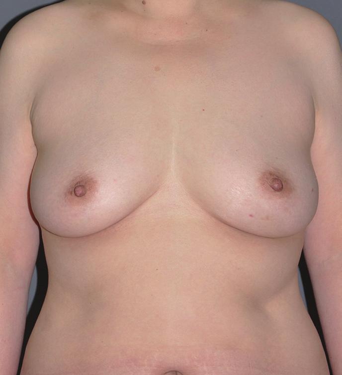(C) 10-month postoperative outcome. A B C the nipple. Follow-up core needle biopsy confirmed the presence of DCIS.
