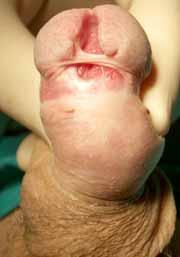 dehiscence meatal stenosis 30% of