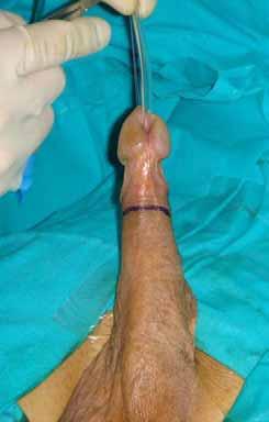 In patients with penile urethral