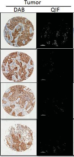 Comparing Commercial IHC Assays IHC-based comparison of anti-pd-l1 clones SP142, E1L3N, 9A11, SP263, 22c3, and 28-8 High concordance in