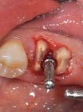 The last instrument used for placement of a 4 11-mm implant was 3.