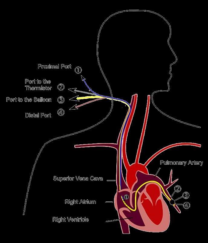 Thermodilution Typical Invasive Hemodynamic Monitoring Application: Pulmonary artery catheter (PAC) Bolus application with cold water (10 C, 5-10 ml) into