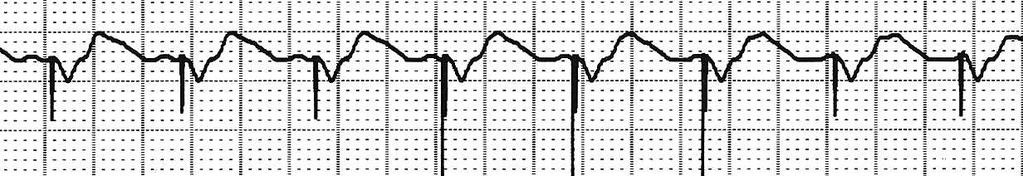 ventricular response to AT/AF DDD tracking the AF May limit patient symptoms