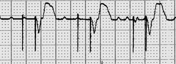 72 Diagnose This Strip Undersensing, the device fails to reliably see P-waves How do we know this is undersensing?