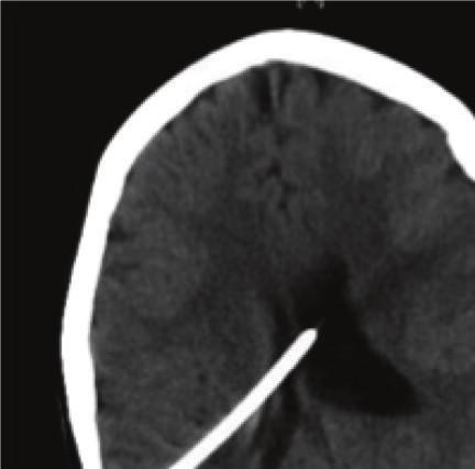 2 Case Reports in Neurological Medicine (a) (b) Figure 1: Computed Tomography of the brain demonstrating dilated ventricular system as a sign of ventriculoperitoneal shunt malfunction (a) and the
