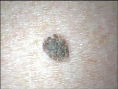Curettage Lesion selection Suitable pathology Easily distinguished from normal skin Size (usually < 1cm) Site considerations