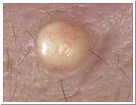 Indications Benign lesions Seb keratoses Solar keratoses Molluscum contagiosum Pyogenic granuloma Milia Warts Sebaceous