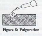 Electrofulguration fulgur act of lightning monoterminal without dispersive plate Electrode not in contact