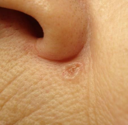 BASAL CELL CARCINOMA (BCC) Most common form of skin cancer Locally invasive, aggressive, and destructive