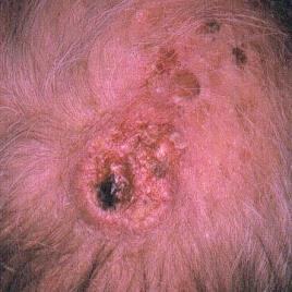 SQUAMOUS CELL CARCINOMA (scc) Second most common form of skin cancer Lesion is metastatic 5 year survival rate 14 39%
