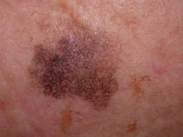 Type III: Acral lentiginous melanoma (2-8%) Seen in 29% to