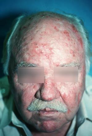 Actinic Keratosis (AK) Appears as a poorly circumscribed, pink, red or